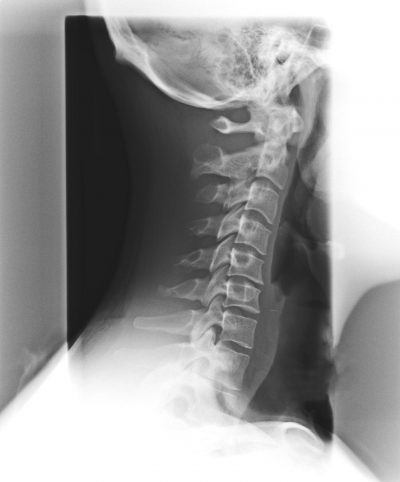 Phase 2 spinal degeneration