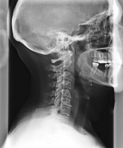 Phase 3 spinal degeneration